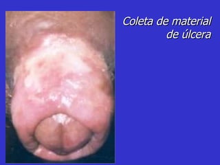 Coleta de material de úlcera 