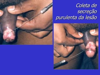 Coleta de secreção purulenta da lesão 