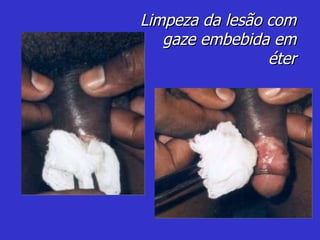Limpeza da lesão com gaze embebida em éter 