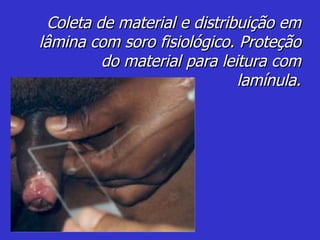 Coleta de material e distribuição em lâmina com soro fisiológico. Proteção do material para leitura com lamínula. 