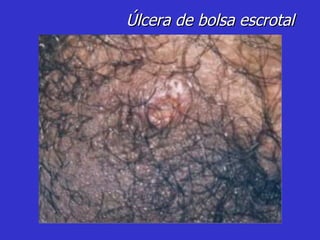 Úlcera de bolsa escrotal 