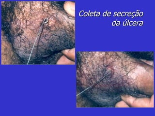 Coleta de secreção da úlcera 