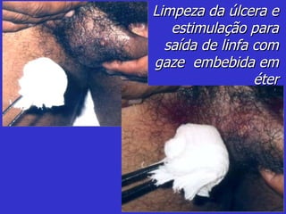 Limpeza da úlcera e estimulação para saída de linfa com gaze  embebida em éter 