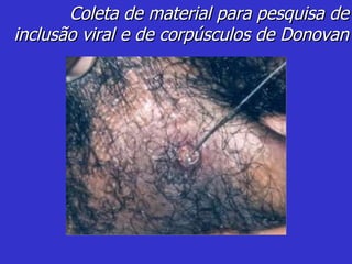 Coleta de material para pesquisa de inclusão viral e de corpúsculos de Donovan 