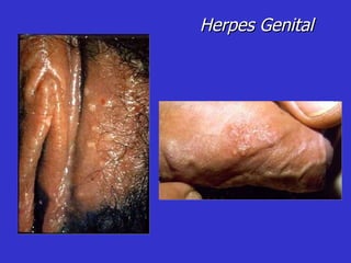 Herpes Genital 