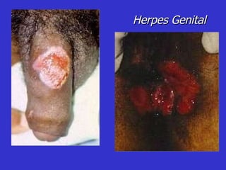Herpes Genital 