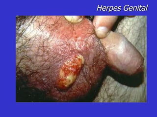 Herpes Genital 