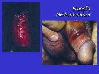 Erupção Medicamentosa 