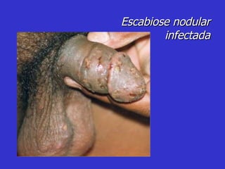 Escabiose nodular infectada 