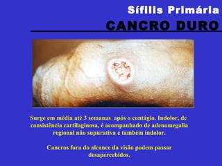 Sífilis Primária CANCRO DURO Surge em média até 3 semanas  após o contágio. Indolor, de  consistência cartilaginosa, é acompanhado de adenomegalia regional não supurativa e também indolor. Cancros fora do alcance da visão podem passar desapercebidos. 