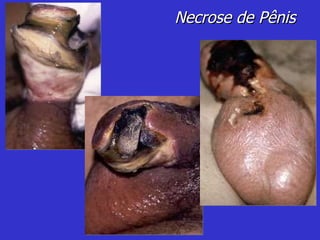 Necrose de Pênis 