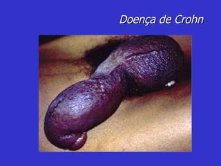 Doença de Crohn 