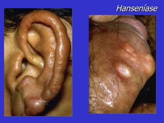 Hanseníase 