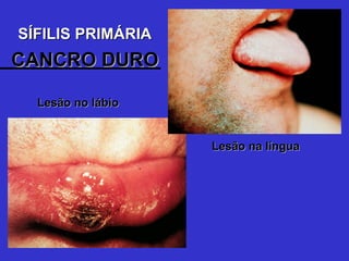 Lesão no lábio Lesão na língua SÍFILIS PRIMÁRIA CANCRO DURO 