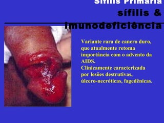 Sífilis Primária sífilis & imunodeficiência Variante rara de cancro duro, que atualmente retoma importância com o advento da AIDS.  Clinicamente caracterizada por lesões destrutivas,  úlcero-necróticas, fagedênicas. 