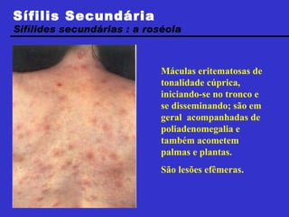 Máculas eritematosas de tonalidade cúprica, iniciando-se no tronco e se disseminando; são em geral  acompanhadas de poliadenomegalia e também acometem palmas e plantas.  São lesões efêmeras. Sífilis Secundária Sifílides secundárias : a roséola  