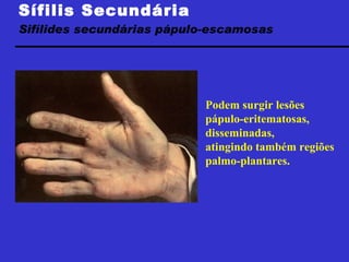 Sífilis Secundária Sifílides secundárias pápulo-escamosas  Foto:Jorge Fagundes Podem surgir lesões pápulo-eritematosas, disseminadas, atingindo também regiões palmo-plantares. 
