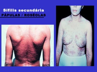 Sífilis secundária PÁPULAS / ROSÉOLAS 