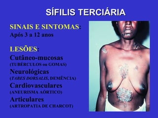 SINAIS E SINTOMAS :  Após  3 a 12  anos LESÕES : Cutâneo-mucosas  (TUBÉRCULOS ou GOMAS ) Neurológicas  ( TABES DORSALIS , DEMÊNCIA) Cardiovasculares  (ANEURISMA AÓRTICO) Articulares  (ARTROPATIA DE CHARCOT) SÍFILIS TERCIÁRIA 