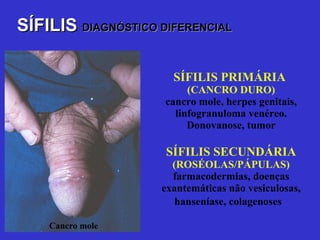 SÍFILIS PRIMÁRIA  (CANCRO DURO) cancro mole, herpes genitais, linfogranuloma venéreo. Donovanose, tumor SÍFILIS SECUNDÁRIA (ROSÉOLAS/PÁPULAS) farmacodermias, doenças exantemáticas não vesiculosas, hanseníase, colagenoses   SÍFILIS   DIAGNÓSTICO DIFERENCIAL Cancro mole 