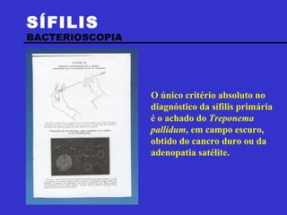 SÍFILIS   BACTERIOSCOPIA O único critério absoluto no diagnóstico da sífilis primária é o achado do  Treponema pallidum , em campo escuro, obtido do cancro duro ou da adenopatia satélite. 