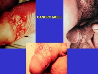 CANCRO MOLE 