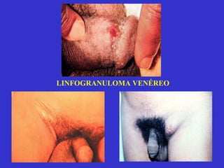 LINFOGRANULOMA VENÉREO 