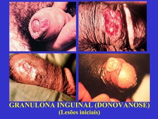 GRANULONA INGUINAL (DONOVANOSE) (Lesões iniciais) 