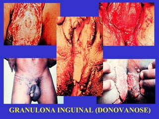 GRANULONA INGUINAL (DONOVANOSE) 