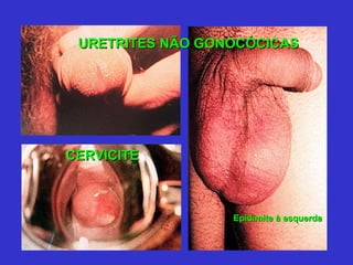 URETRITES NÃO GONOCÓCICAS CERVICITE Epidimite à esquerda 