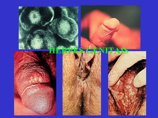HERPES GENITAIS 