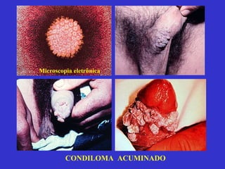 CONDILOMA  ACUMINADO Microscopia eletrônica 