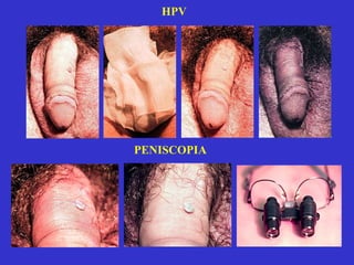 PENISCOPIA HPV 