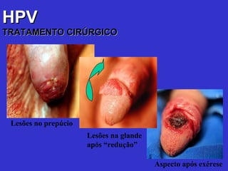HPV   TRATAMENTO CIRÚRGICO Lesões no prepúcio Aspecto após exérese Lesões na glande após “redução” 