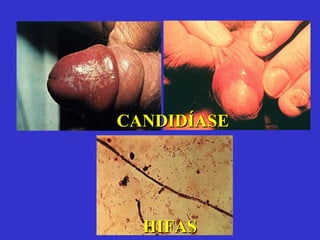 CANDIDÍASE HIFAS 