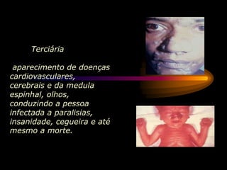 Terciária
aparecimento de doenças
cardiovasculares,
cerebrais e da medula
espinhal, olhos,
conduzindo a pessoa
infectada a paralisias,
insanidade, cegueira e até
mesmo a morte.
 