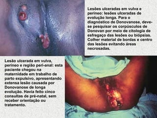 Lesões ulceradas em vulva e períneo: lesões ulceradas de evolução longa. Para o diagnóstico de Donovanose, deve-se pesquisar os corpúsculos de Donovan por meio de citologia de esfregaço das lesões ou biópsias. Colher material de bordas e centro das lesões evitando áreas necrosadas.   Lesão ulcerada em vulva, períneo e região peri-anal: esta paciente chegou na maternidade em trabalho de parto expulsivo, apresentando extensa lesão causada por Donovanose de longa evolução. Havia feito cinco consultas de pré-natal, sem receber orientação ou tratamento.   