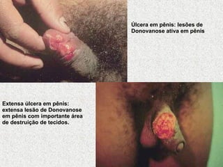 Úlcera em pênis: lesões de Donovanose ativa em pênis   Extensa úlcera em pênis: extensa lesão de Donovanose em pênis com importante área de destruição de tecidos.   