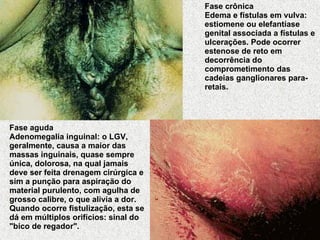 Fase crônica Edema e fístulas em vulva: estiomene ou elefantíase genital associada a fístulas e ulcerações. Pode ocorrer estenose de reto em decorrência do comprometimento das cadeias ganglionares para-retais.   Fase aguda Adenomegalia inguinal: o LGV, geralmente, causa a maior das massas inguinais, quase sempre única, dolorosa, na qual jamais deve ser feita drenagem cirúrgica e sim a punção para aspiração do material purulento, com agulha de grosso calibre, o que alivia a dor. Quando ocorre fistulização, esta se dá em múltiplos orifícios: sinal do "bico de regador".   