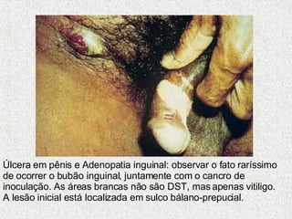 Úlcera em pênis e Adenopatia inguinal: observar o fato raríssimo de ocorrer o bubão inguinal, juntamente com o cancro de inoculação. As áreas brancas não são DST, mas apenas vitiligo. A lesão inicial está localizada em sulco bálano-prepucial.  