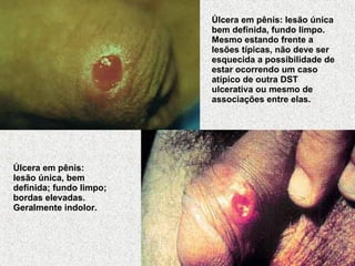 Úlcera em pênis: lesão única bem definida, fundo limpo. Mesmo estando frente a lesões típicas, não deve ser esquecida a possibilidade de estar ocorrendo um caso atípico de outra DST ulcerativa ou mesmo de associações entre elas.   Úlcera em pênis: lesão única, bem definida; fundo limpo; bordas elevadas. Geralmente indolor.   