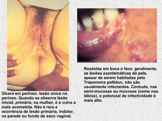 Úlcera em períneo: lesão única no períneo. Quando se observa lesão inicial, primária, na mulher, é a vulva a mais acometida. Não é rara a ocorrência de lesão primária, indolor, na parede ou fundo de saco vaginal.   Roséolas em boca e face: geralmente, as lesões exantemáticas da pele, apesar de serem habitadas pelo Treponema pallidun, não são usualmente infectantes. Contudo, nas semi-mucosas ou mucosas (como nos lábios), o potencial de infectividade é mais alto.   