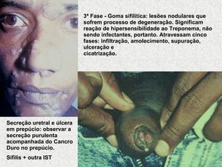 3ª Fase - Goma sifilítica: lesões nodulares que sofrem processo de degeneração. Significam reação de hipersensibilidade ao Treponema, não sendo infectantes, portanto. Atravessam cinco fases: infiltração, amolecimento, supuração, ulceração e cicatrização.                                                                      Secreção uretral e úlcera em prepúcio: observar a secreção purulenta acompanhada do Cancro Duro no prepúcio.   Sífilis + outra IST 