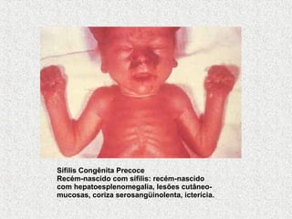 Sífilis Congênita Precoce Recém-nascido com sífilis: recém-nascido com hepatoesplenomegalia, lesões cutâneo-mucosas, coriza serosangüinolenta, icterícia. 