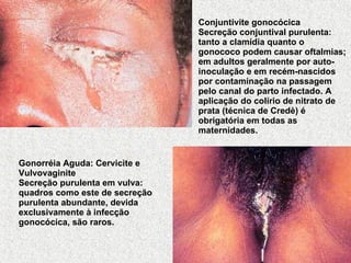 Conjuntivite gonocócica Secreção conjuntival purulenta: tanto a clamídia quanto o gonococo podem causar oftalmias; em adultos geralmente por auto-inoculação e em recém-nascidos por contaminação na passagem pelo canal do parto infectado. A aplicação do colírio de nitrato de prata (técnica de Credè) é obrigatória em todas as maternidades. Gonorréia Aguda: Cervicite e Vulvovaginite Secreção purulenta em vulva: quadros como este de secreção purulenta abundante, devida exclusivamente à infecção gonocócica, são raros. 