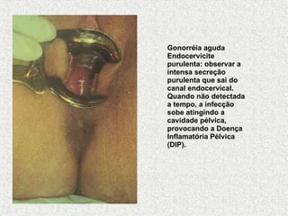 Gonorréia aguda Endocervicite purulenta: observar a intensa secreção purulenta que sai do canal endocervical. Quando não detectada a tempo, a infecção sobe atingindo a cavidade pélvica, provocando a Doença Inflamatória Pélvica (DIP). 