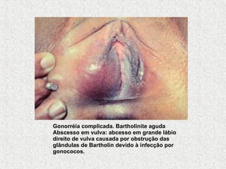 Gonorréia complicada. Bartholinite aguda Abscesso em vulva: abcesso em grande lábio direito de vulva causada por obstrução das glândulas de Bartholin devido à infecção por gonococos. 