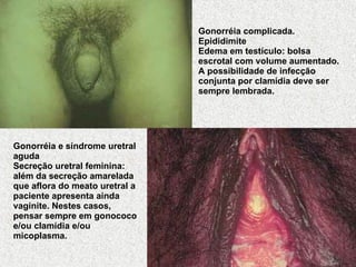 Gonorréia complicada. Epididimite Edema em testículo: bolsa escrotal com volume aumentado. A possibilidade de infecção conjunta por clamídia deve ser sempre lembrada. Gonorréia e síndrome uretral aguda Secreção uretral feminina: além da secreção amarelada que aflora do meato uretral a paciente apresenta ainda vaginite. Nestes casos, pensar sempre em gonococo e/ou clamídia e/ou micoplasma. 