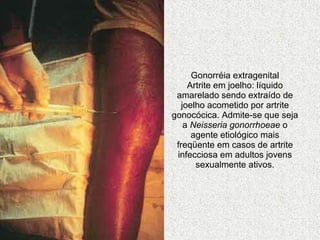 Gonorréia extragenital Artrite em joelho: líquido amarelado sendo extraído de joelho acometido por artrite gonocócica. Admite-se que seja a  Neisseria gonorrhoeae  o agente etiológico mais freqüente em casos de artrite infecciosa em adultos jovens sexualmente ativos. 