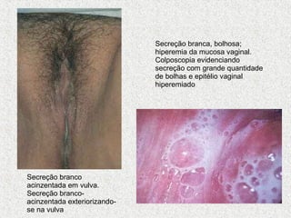 Secreção branco acinzentada em vulva. Secreção branco-acinzentada exteriorizando-se na vulva  Secreção branca, bolhosa; hiperemia da mucosa vaginal. Colposcopia evidenciando secreção com grande quantidade de bolhas e epitélio vaginal hiperemiado  